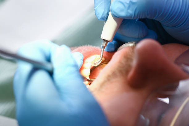 Best Emergency Wisdom Teeth Removal in Blue Ridge, VA